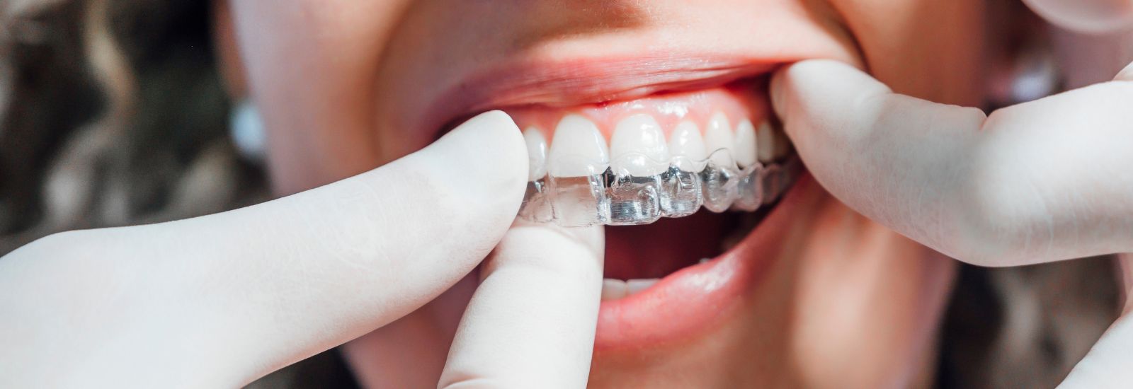 Invisalign inserting to a patient