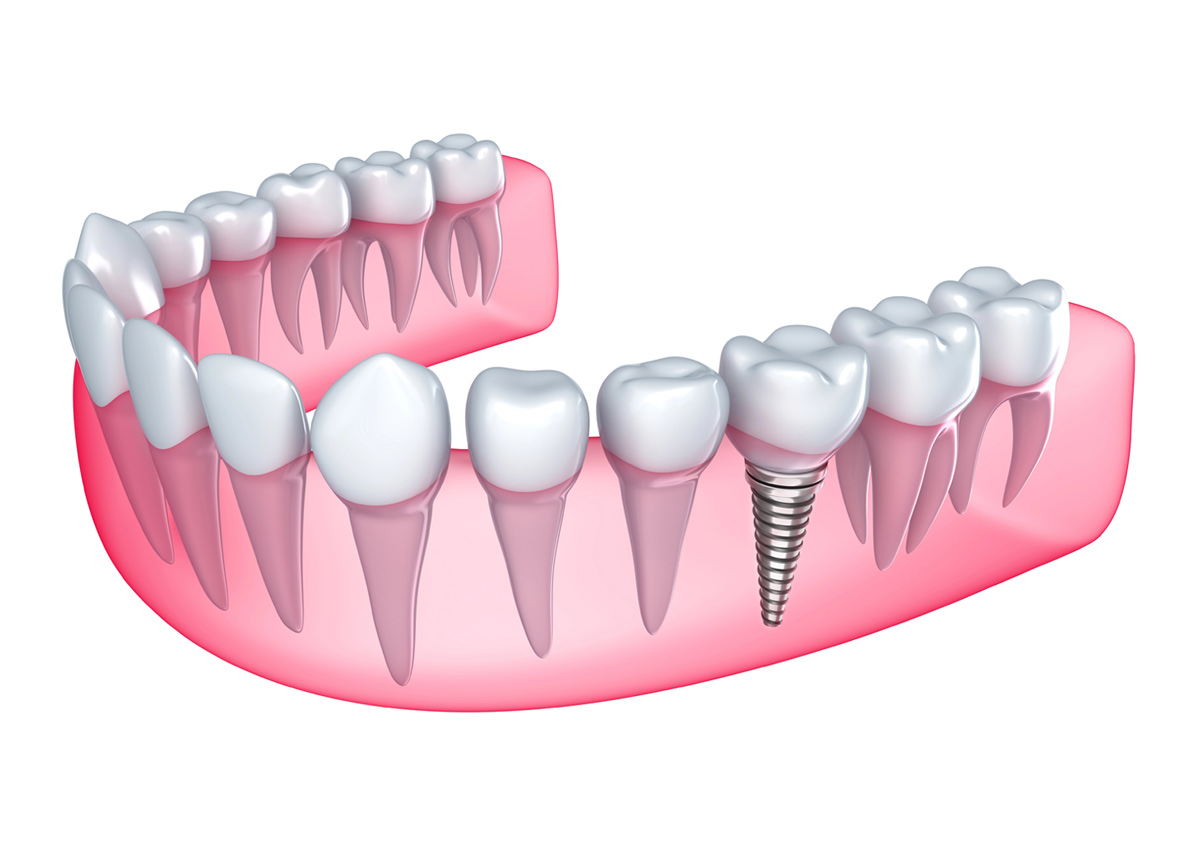 Single Tooth Dental Implants Danville CA